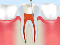 小児歯科の歯根治療