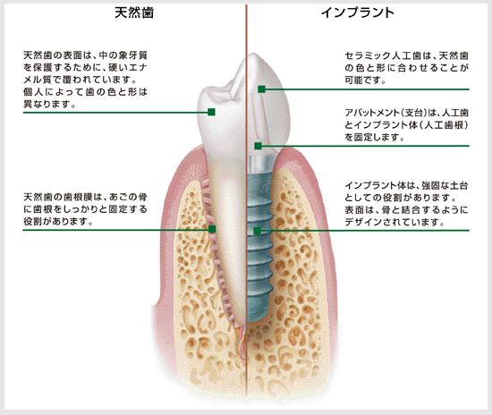 インプラントとは