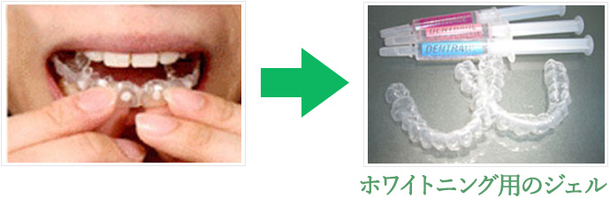 自宅でできるホームホワイトニング